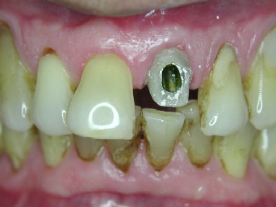 21 Abutment with composite core.jpg